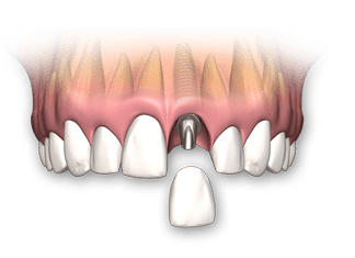 implantes de un solo diente huancayo-min