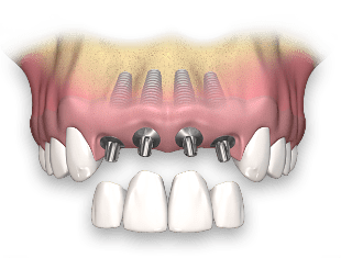 implantes dentales multiples en huancayo